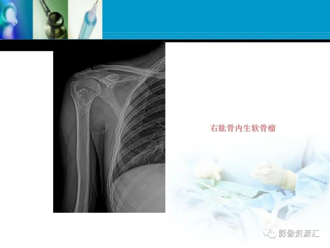 影像PPT - 【PPT】软骨粘液纤维性瘤-27