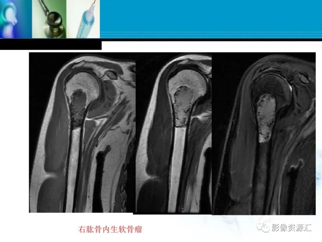 影像PPT - 【PPT】软骨粘液纤维性瘤-28