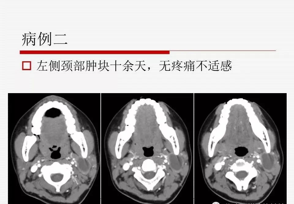 影像PPT - 颈部肿块影像诊断与鉴别诊断—鳃裂囊肿-5