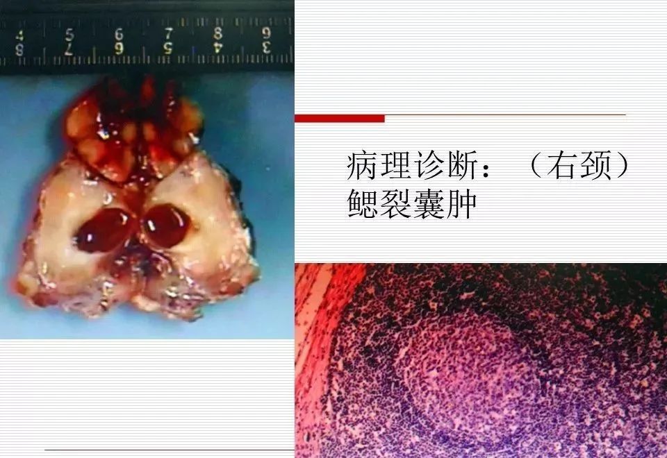 影像PPT - 颈部肿块影像诊断与鉴别诊断—鳃裂囊肿-4