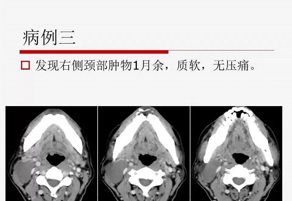 影像PPT - 颈部肿块影像诊断与鉴别诊断—鳃裂囊肿-7