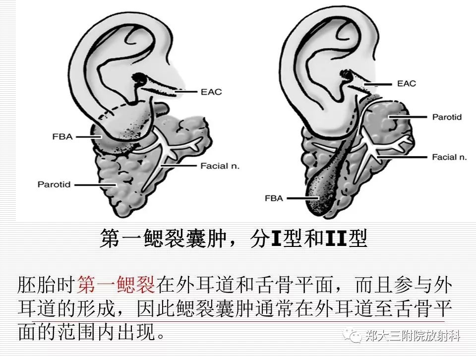 影像PPT - 颈部肿块影像诊断与鉴别诊断—鳃裂囊肿-18