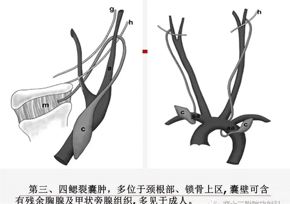 影像PPT - 颈部肿块影像诊断与鉴别诊断—鳃裂囊肿-20