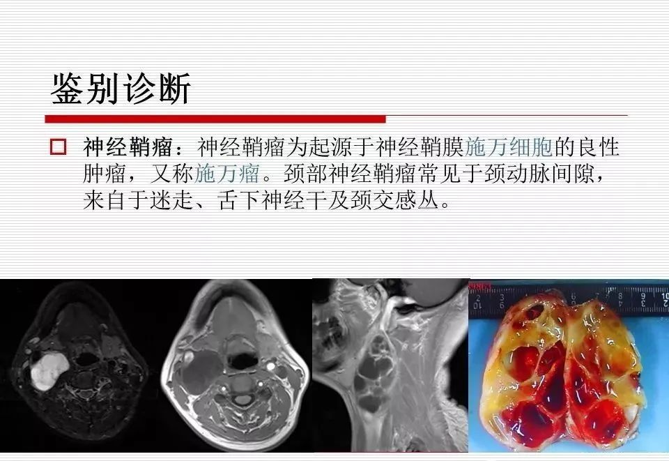 影像PPT - 颈部肿块影像诊断与鉴别诊断—鳃裂囊肿-25