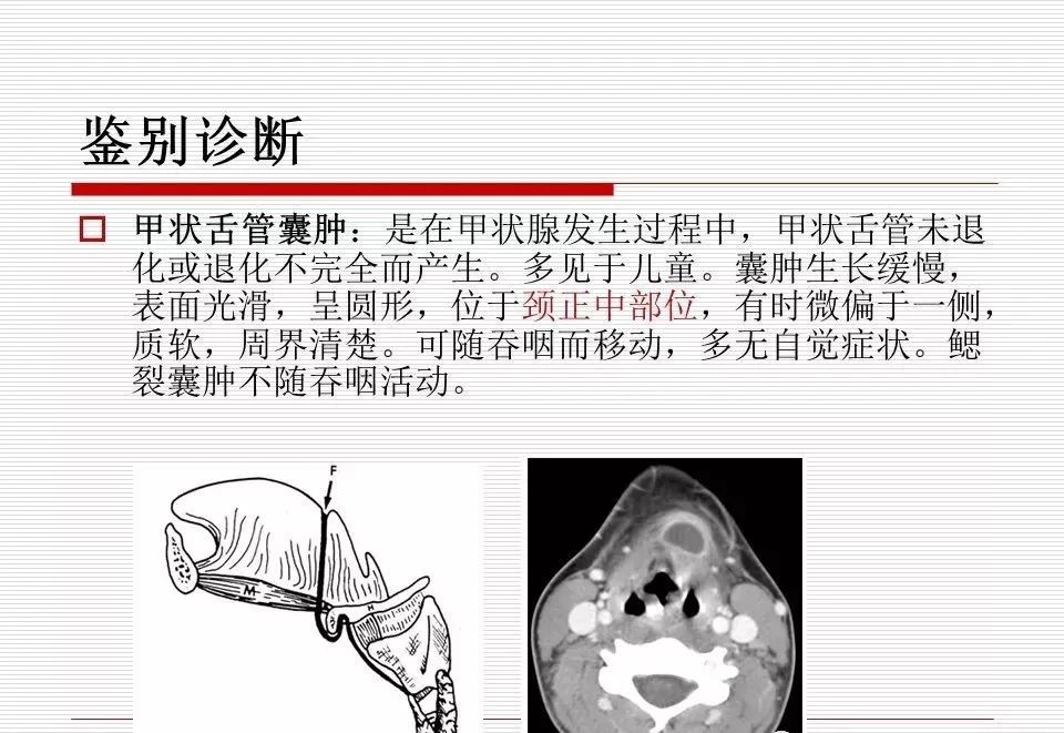 影像PPT - 颈部肿块影像诊断与鉴别诊断—鳃裂囊肿-26