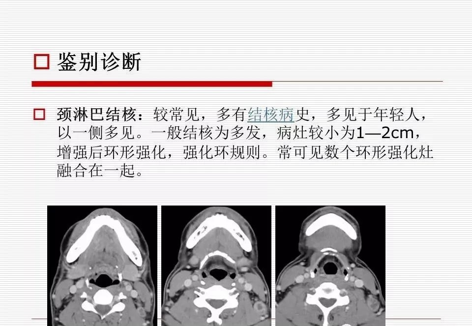 影像PPT - 颈部肿块影像诊断与鉴别诊断—鳃裂囊肿-28