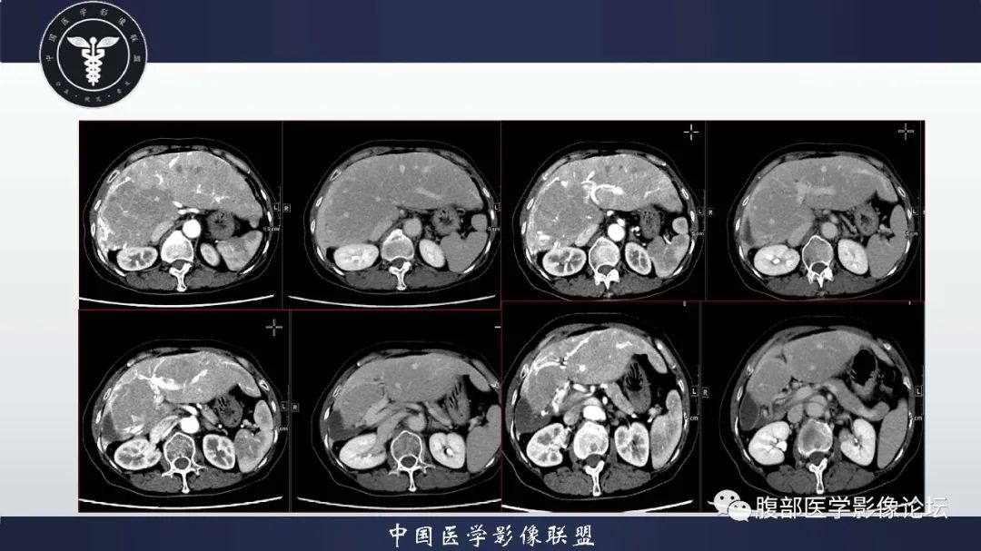 影像PPT - 【病例】肝脏遗传性出血性毛细血管扩张症2例-4 影像PPT - 【病例】肝脏遗传性出血性毛细血管扩张症2例-4