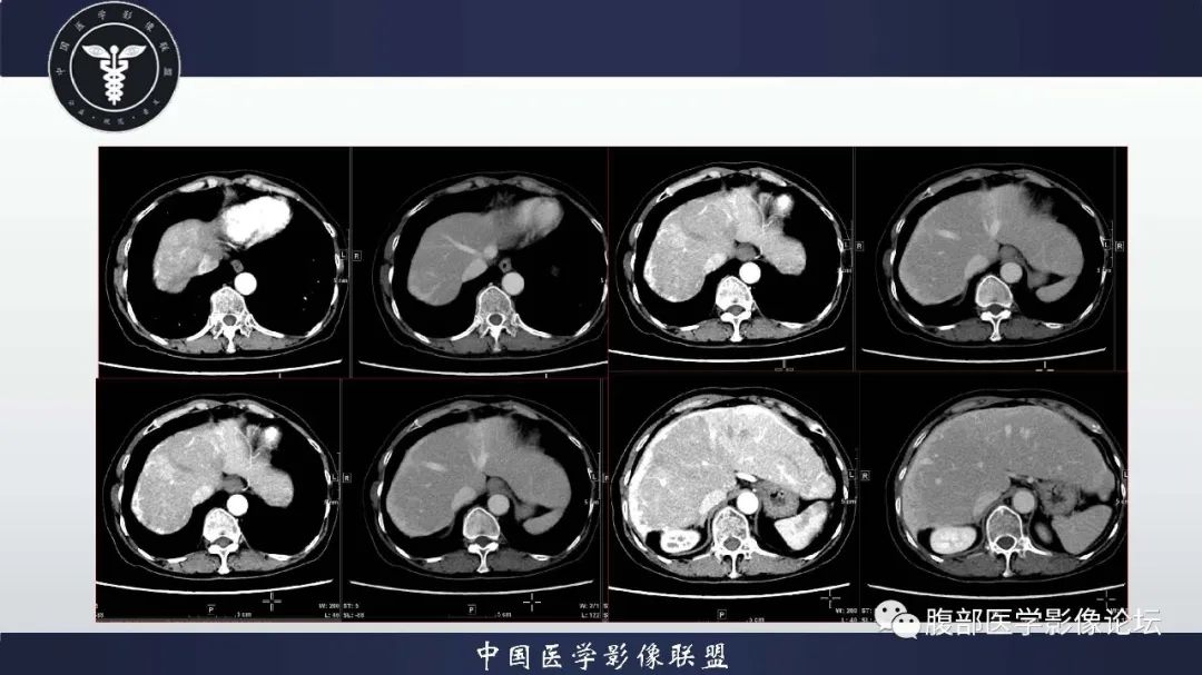 影像PPT - 【病例】肝脏遗传性出血性毛细血管扩张症2例-3 影像PPT - 【病例】肝脏遗传性出血性毛细血管扩张症2例-3