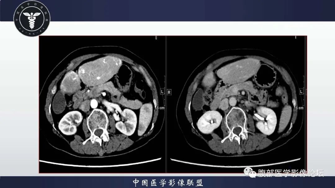 影像PPT - 【病例】肝脏遗传性出血性毛细血管扩张症2例-5 影像PPT - 【病例】肝脏遗传性出血性毛细血管扩张症2例-5