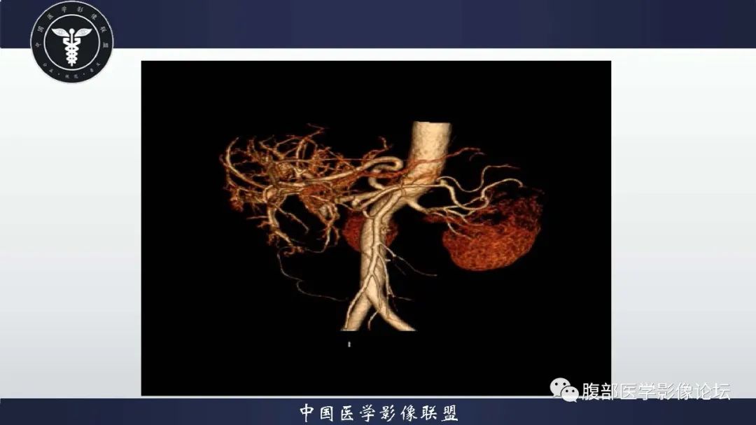 影像PPT - 【病例】肝脏遗传性出血性毛细血管扩张症2例-6 影像PPT - 【病例】肝脏遗传性出血性毛细血管扩张症2例-6