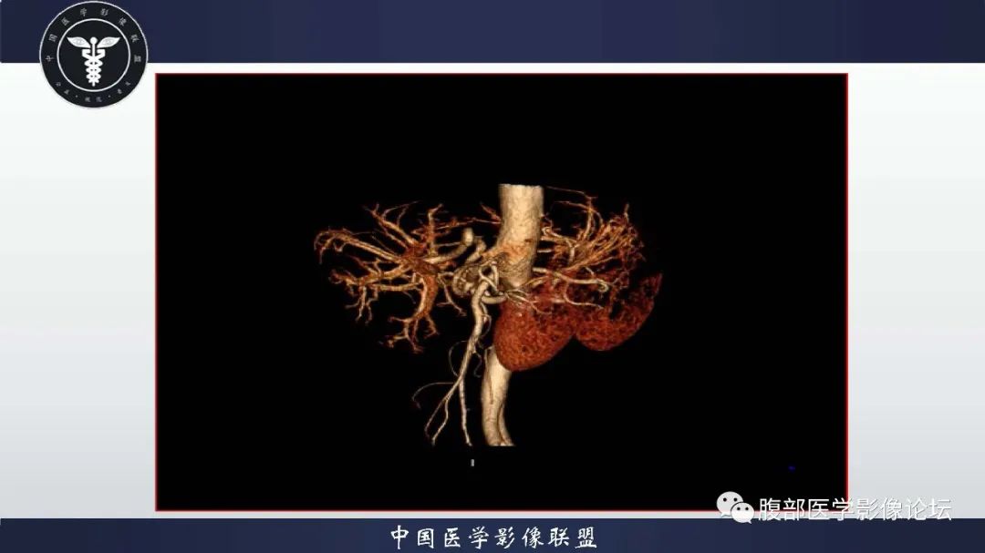 影像PPT - 【病例】肝脏遗传性出血性毛细血管扩张症2例-7 影像PPT - 【病例】肝脏遗传性出血性毛细血管扩张症2例-7