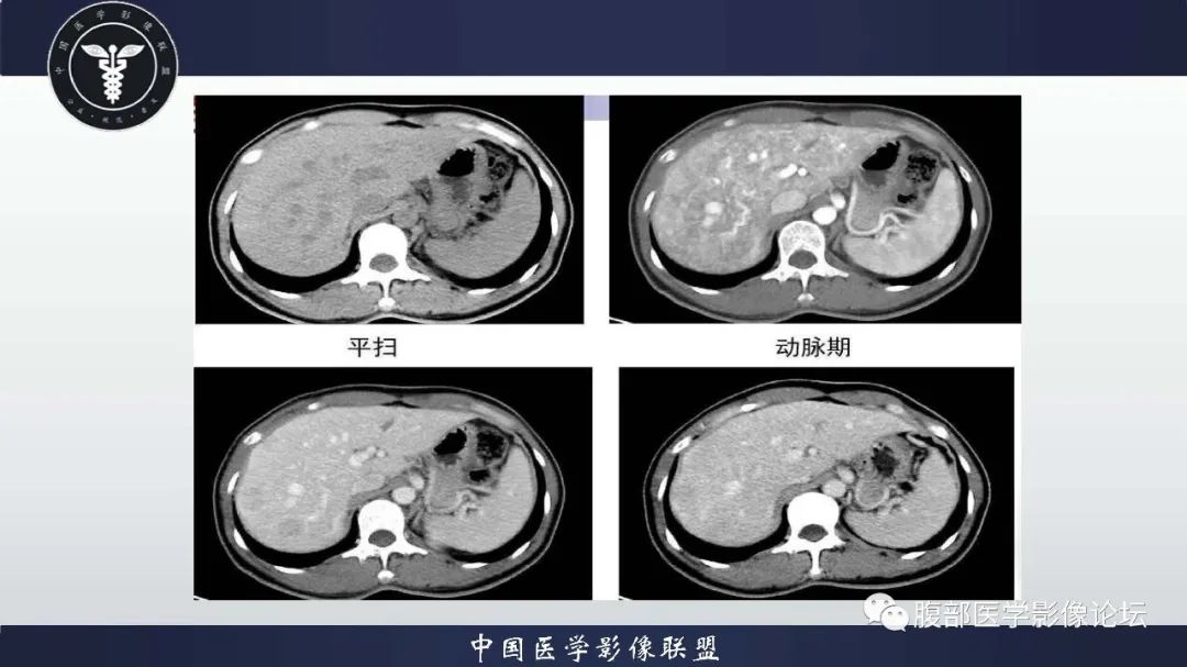 影像PPT - 【病例】肝脏遗传性出血性毛细血管扩张症2例-10 影像PPT - 【病例】肝脏遗传性出血性毛细血管扩张症2例-10