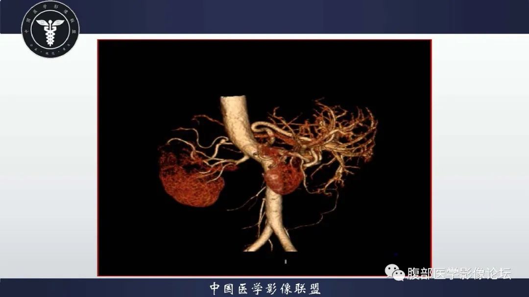 影像PPT - 【病例】肝脏遗传性出血性毛细血管扩张症2例-8 影像PPT - 【病例】肝脏遗传性出血性毛细血管扩张症2例-8