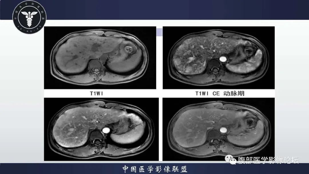影像PPT - 【病例】肝脏遗传性出血性毛细血管扩张症2例-13 影像PPT - 【病例】肝脏遗传性出血性毛细血管扩张症2例-13