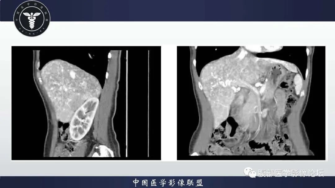 影像PPT - 【病例】肝脏遗传性出血性毛细血管扩张症2例-11 影像PPT - 【病例】肝脏遗传性出血性毛细血管扩张症2例-11
