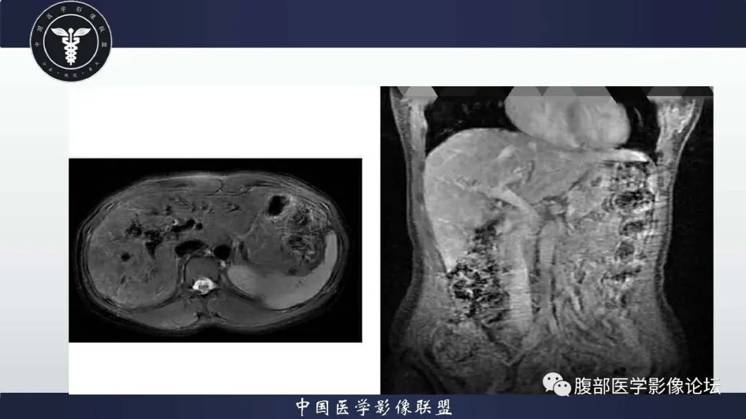 影像PPT - 【病例】肝脏遗传性出血性毛细血管扩张症2例-12 影像PPT - 【病例】肝脏遗传性出血性毛细血管扩张症2例-12