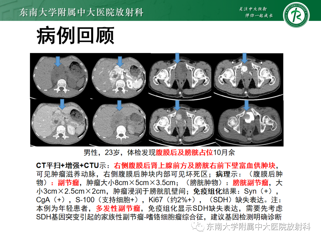 影像PPT - 【PPT】腹膜后副神经节瘤的影像-3