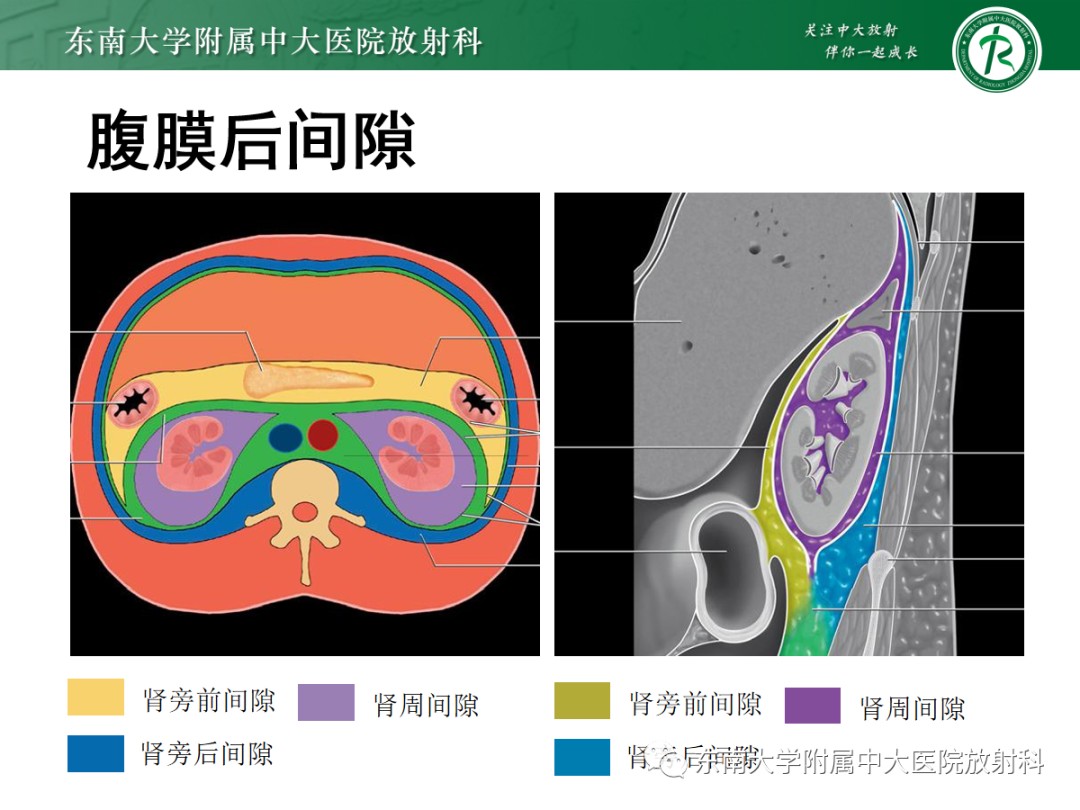 影像PPT - 【PPT】腹膜后副神经节瘤的影像-8