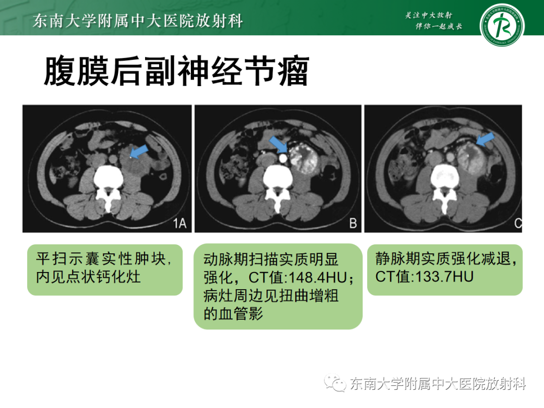 影像PPT - 【PPT】腹膜后副神经节瘤的影像-12
