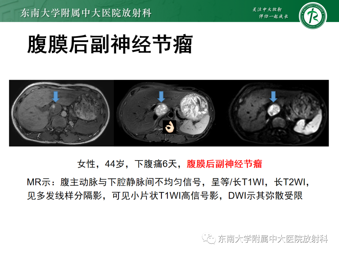 影像PPT - 【PPT】腹膜后副神经节瘤的影像-13