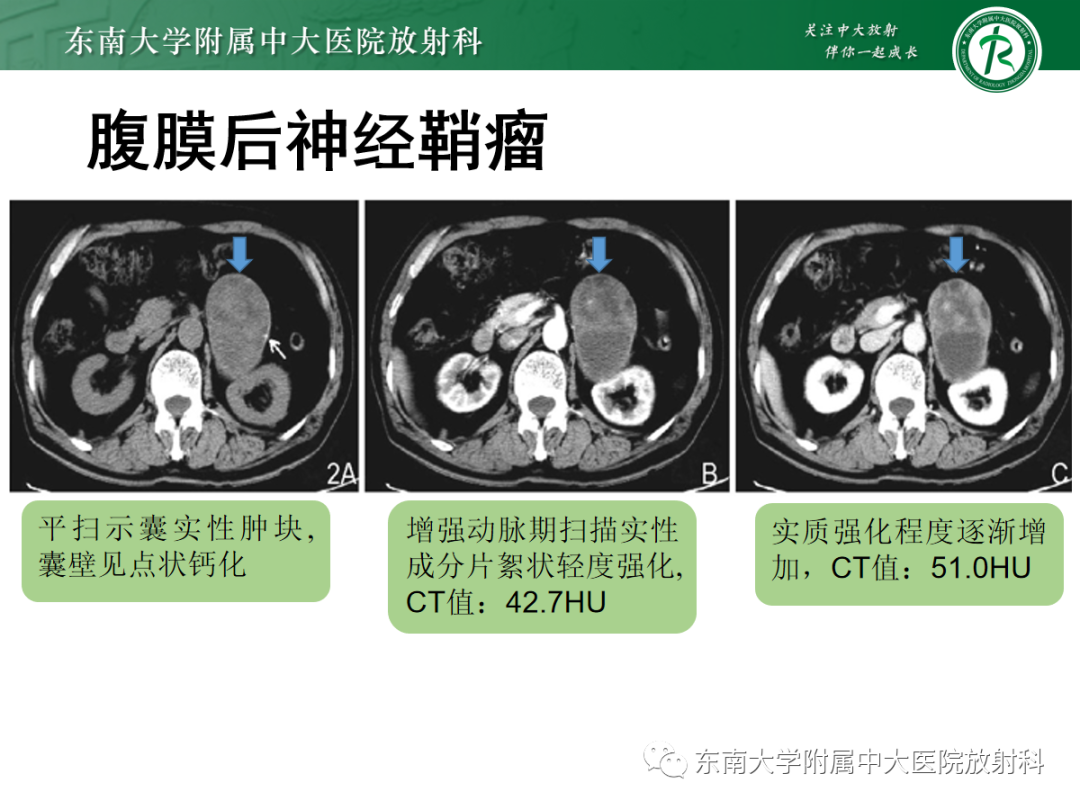 影像PPT - 【PPT】腹膜后副神经节瘤的影像-17