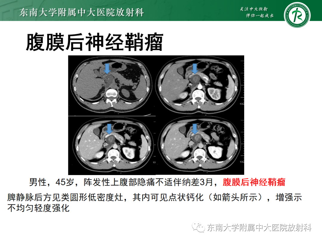影像PPT - 【PPT】腹膜后副神经节瘤的影像-18