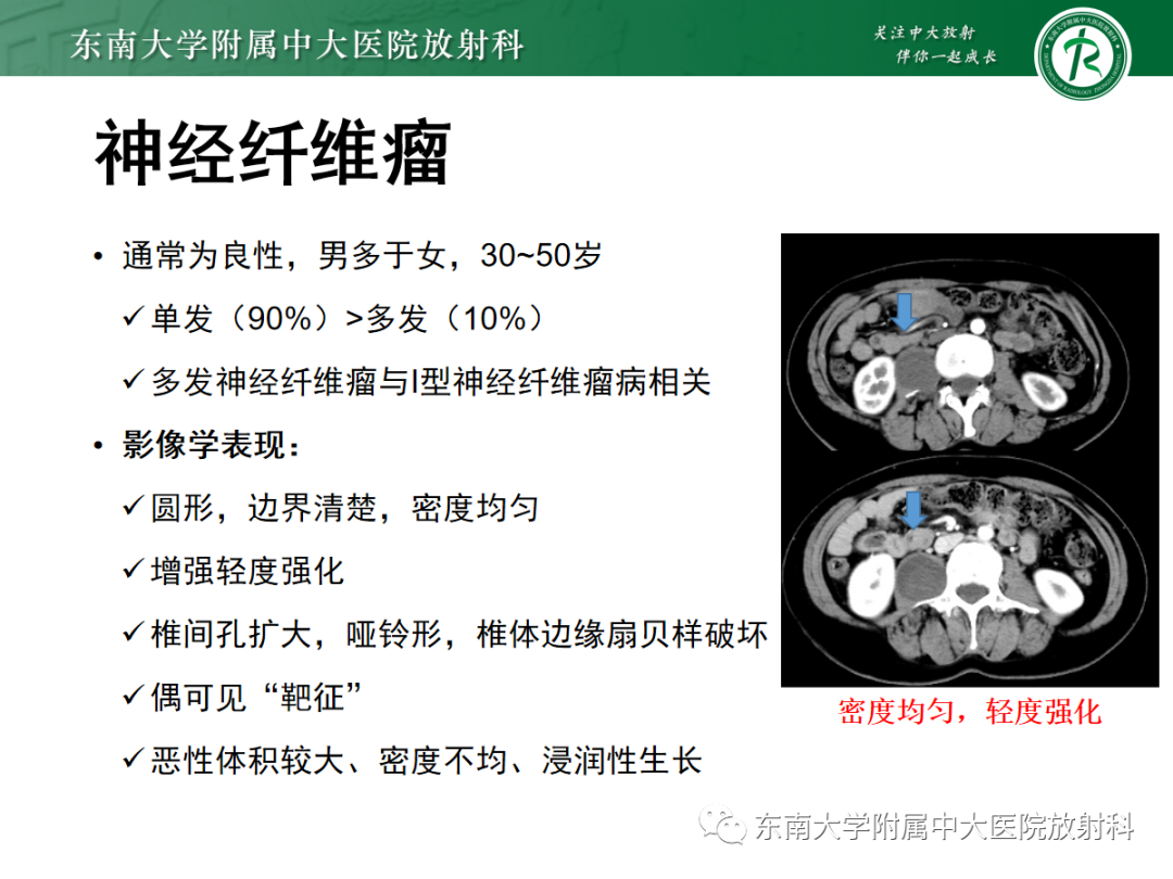 影像PPT - 【PPT】腹膜后副神经节瘤的影像-19