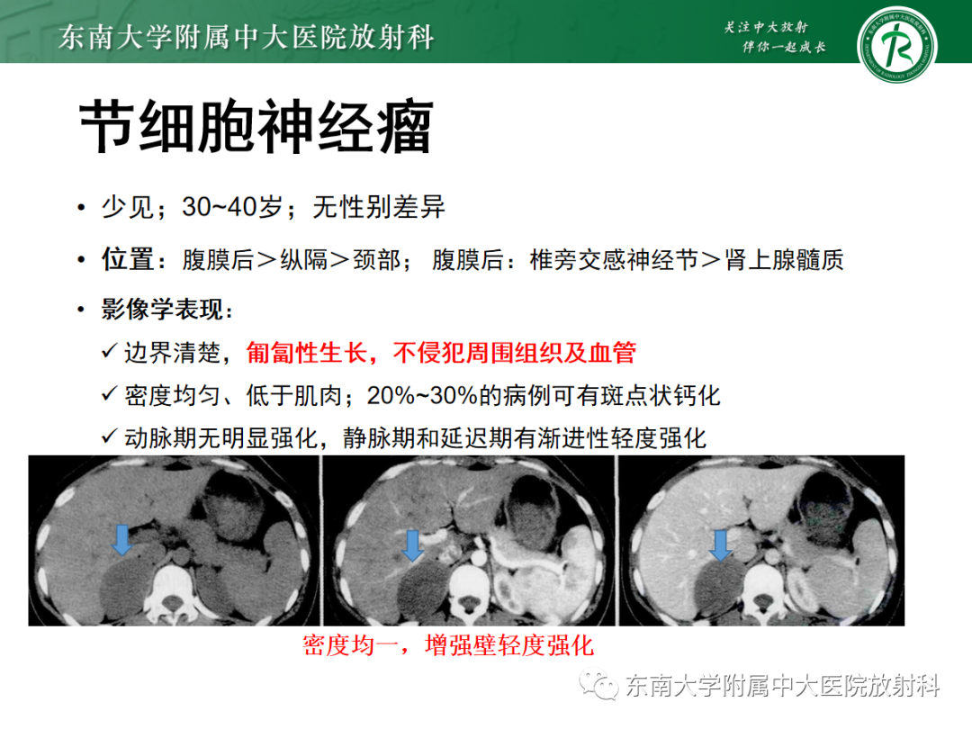 影像PPT - 【PPT】腹膜后副神经节瘤的影像-20