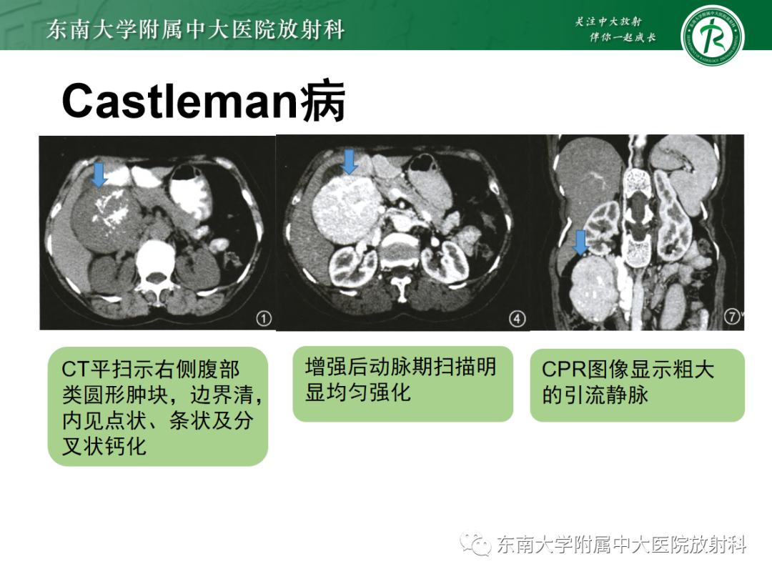 影像PPT - 【PPT】腹膜后副神经节瘤的影像-23