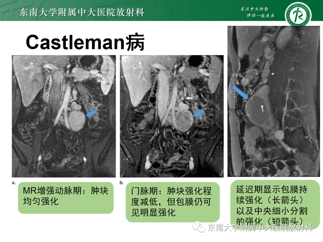 影像PPT - 【PPT】腹膜后副神经节瘤的影像-24
