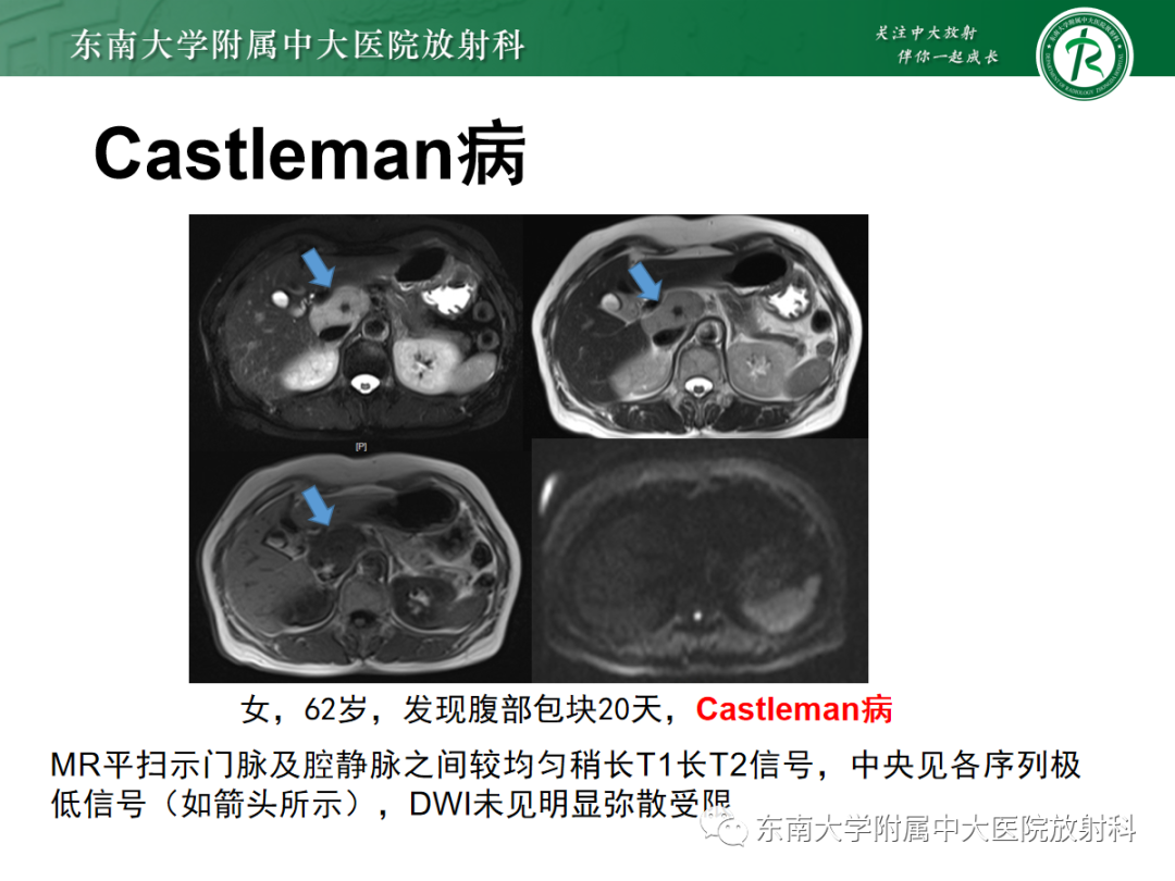 影像PPT - 【PPT】腹膜后副神经节瘤的影像-25