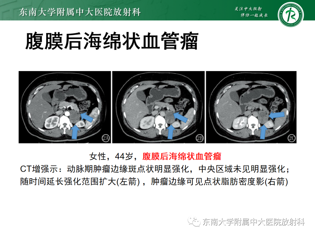 影像PPT - 【PPT】腹膜后副神经节瘤的影像-28
