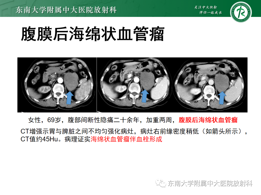 影像PPT - 【PPT】腹膜后副神经节瘤的影像-29