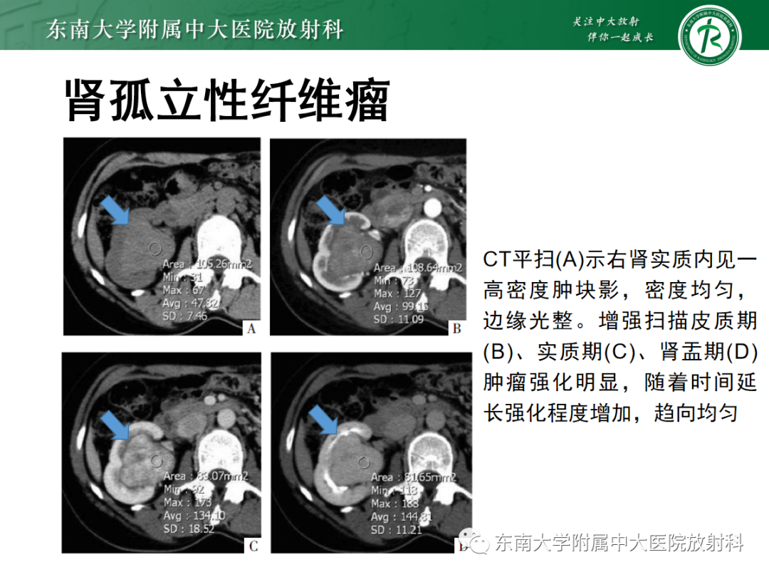 影像PPT - 【PPT】腹膜后副神经节瘤的影像-32