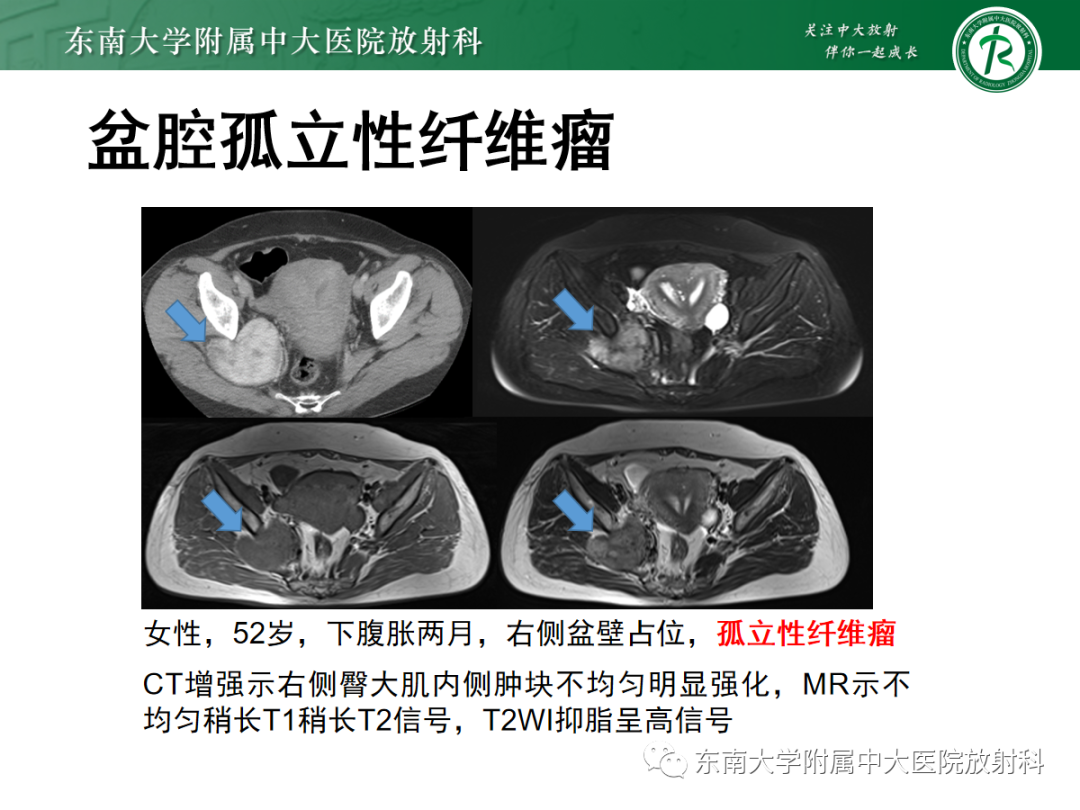 影像PPT - 【PPT】腹膜后副神经节瘤的影像-33