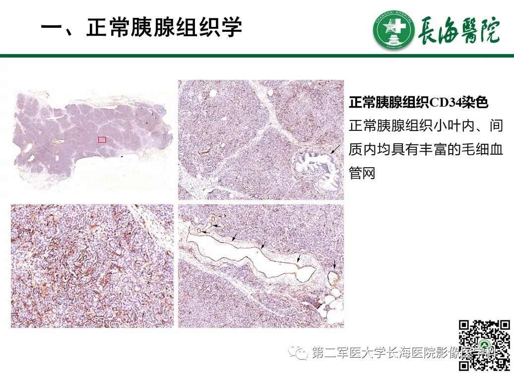 影像PPT - 【PPT】胰腺基本病变：影像与病理-10