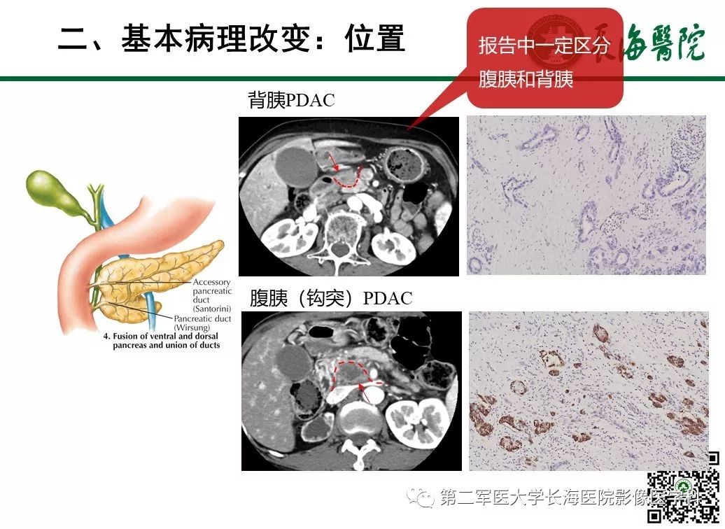 影像PPT - 【PPT】胰腺基本病变：影像与病理-17