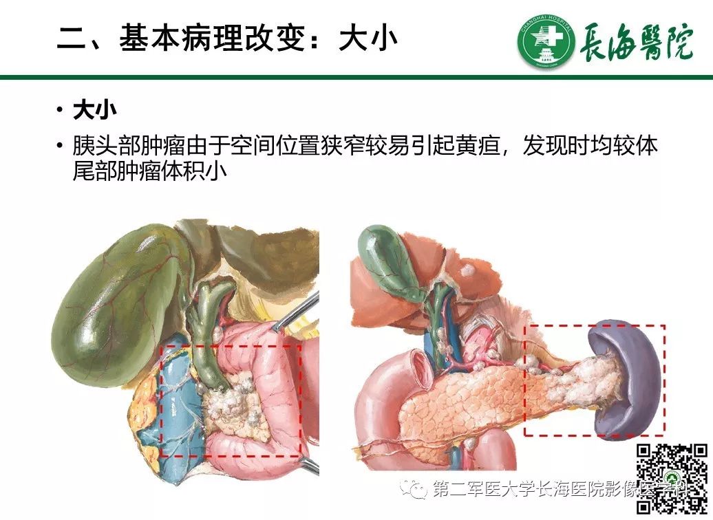 影像PPT - 【PPT】胰腺基本病变：影像与病理-21