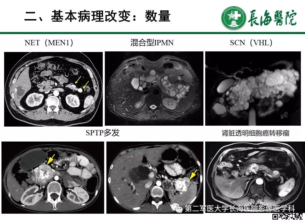 影像PPT - 【PPT】胰腺基本病变：影像与病理-20