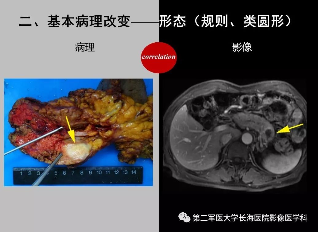 影像PPT - 【PPT】胰腺基本病变：影像与病理-23
