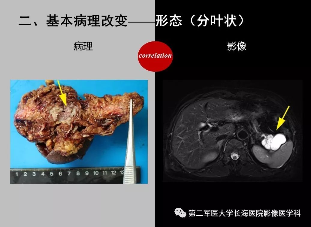 影像PPT - 【PPT】胰腺基本病变：影像与病理-25