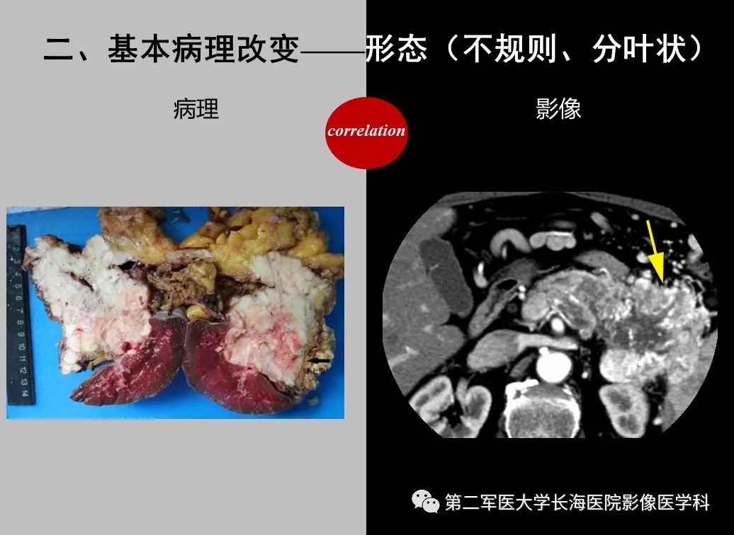 影像PPT - 【PPT】胰腺基本病变：影像与病理-24