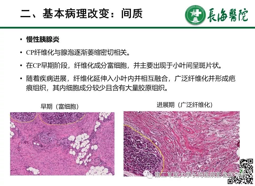 影像PPT - 【PPT】胰腺基本病变：影像与病理-28