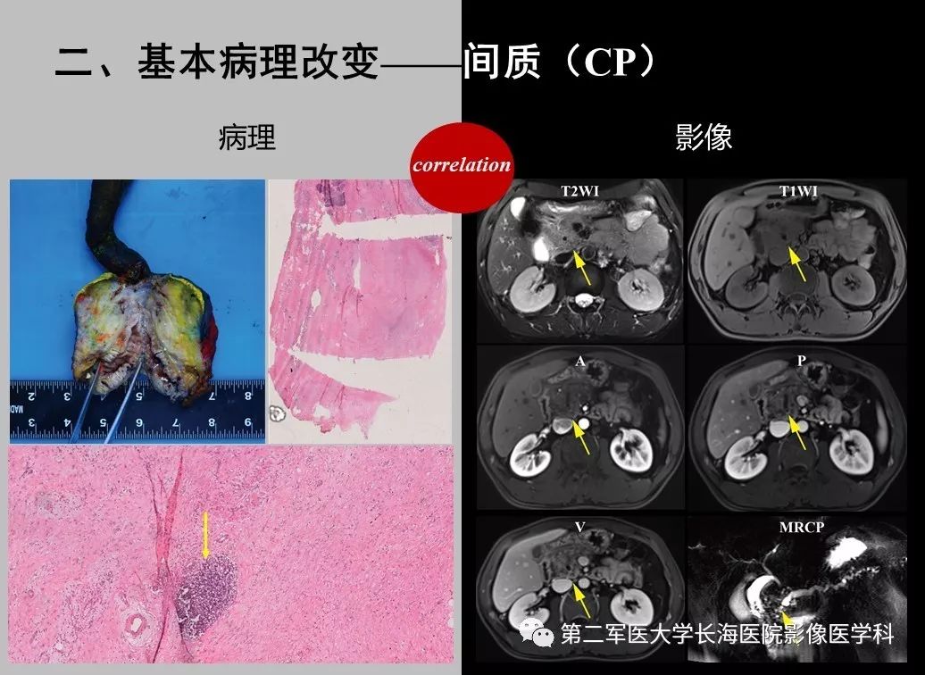 影像PPT - 【PPT】胰腺基本病变：影像与病理-29