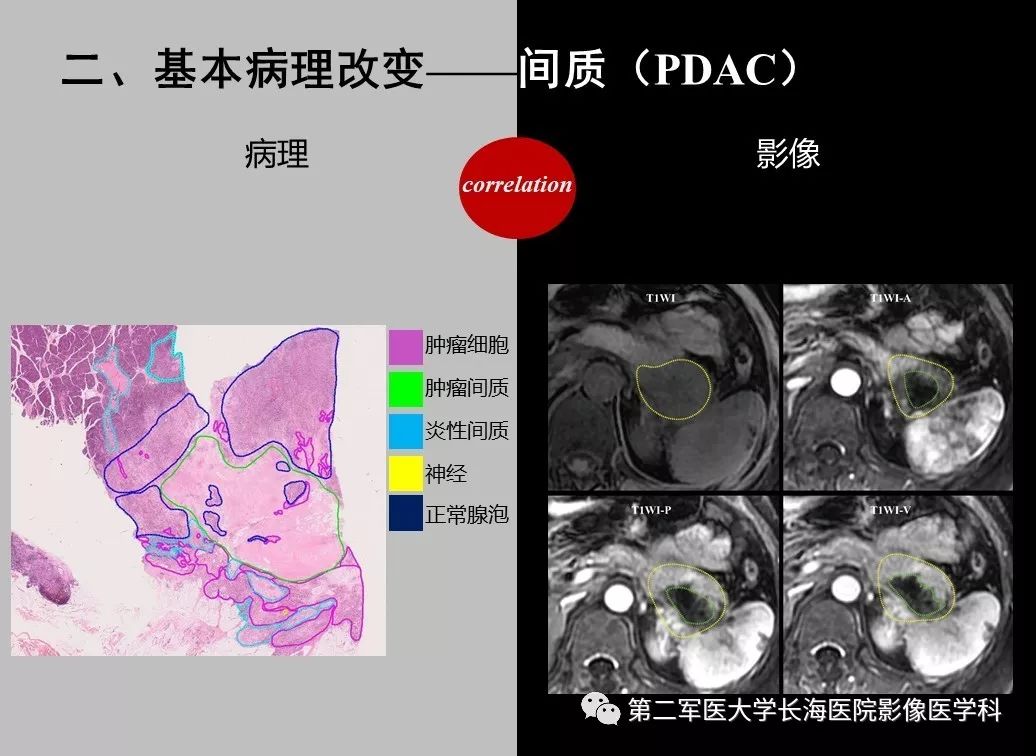 影像PPT - 【PPT】胰腺基本病变：影像与病理-30