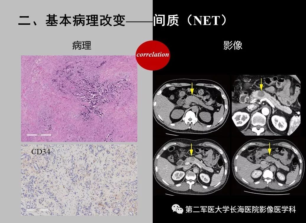 影像PPT - 【PPT】胰腺基本病变：影像与病理-31