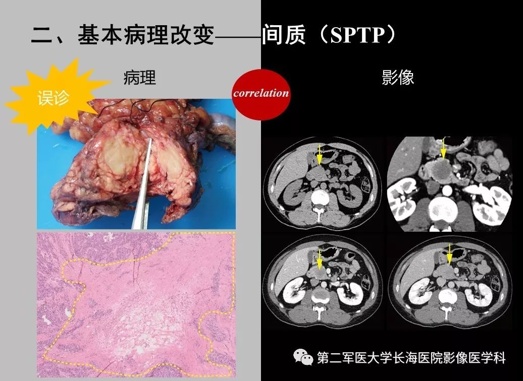 影像PPT - 【PPT】胰腺基本病变：影像与病理-32