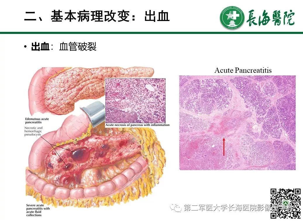 影像PPT - 【PPT】胰腺基本病变：影像与病理-34