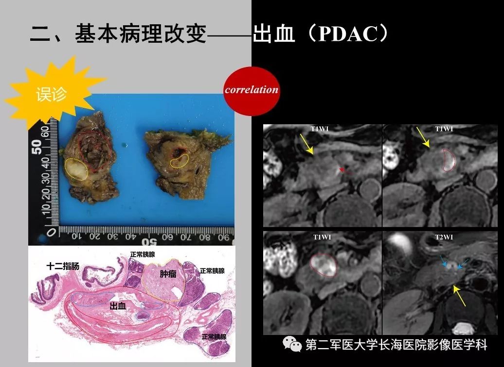 影像PPT - 【PPT】胰腺基本病变：影像与病理-39
