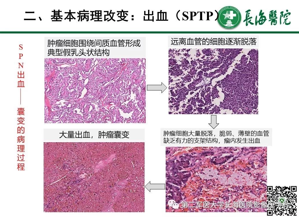 影像PPT - 【PPT】胰腺基本病变：影像与病理-37